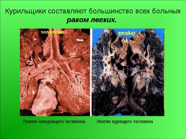Курильщики составляют большинство всех больных раком легких.  Лекгие некурящего человека Лекгие курящего человека 