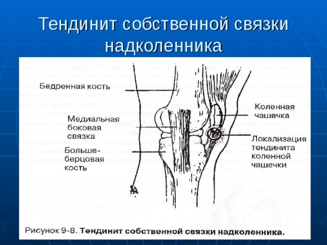 Тендинит собственной связки надколенника 