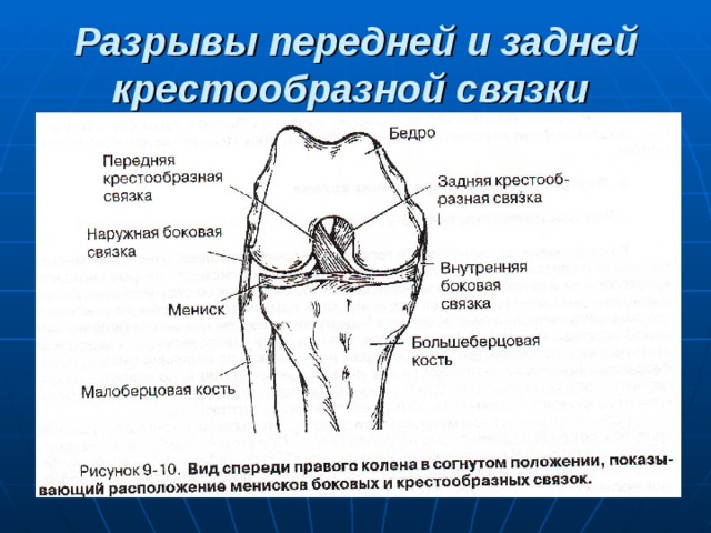 Разрывы передней и задней крестообразной связки  