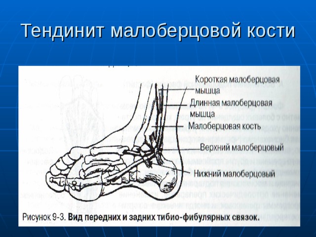 Тендинит малоберцовой кости 