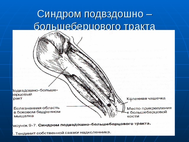 Синдром подвздошно – большеберцового тракта 