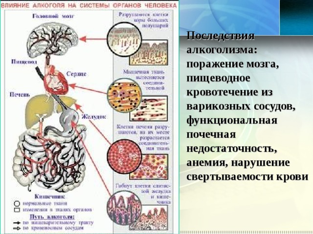 Последствия алкоголизма:  поражение мозга, пищеводное кровотечение из варикозных сосудов, функциональная почечная недостаточность, анемия, нарушение свертываемости крови 