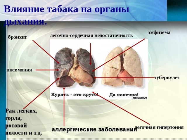Влияние табака на органы дыхания. эмфизема легочно-сердечная недостаточность бронхит пневмония туберкулез Рак легких, горла, ротовой полости и т.д. легочная гипертония аллергические заболевания  