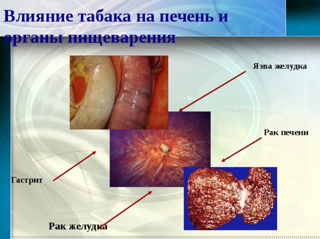 Влияние табака на печень и органы пищеварения Язва желудка Рак печени Гастрит Рак желудка  
