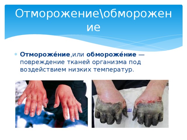Отморожение\обморожение Отмороже́ние ,или  обмороже́ние  — повреждение тканей организма под воздействием низких температур. 