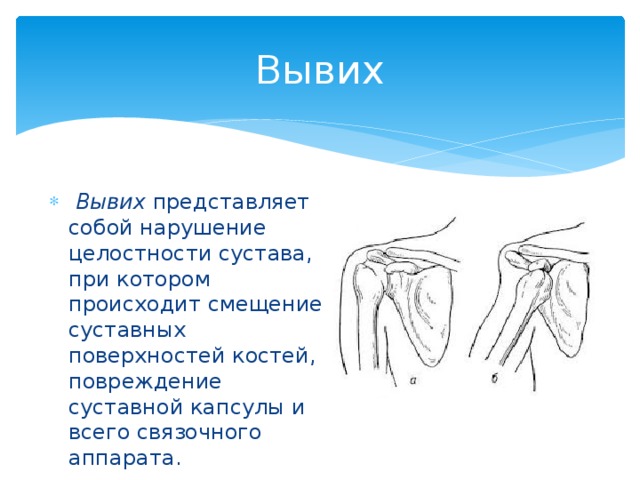 Вывих   Вывих  представляет собой нарушение целостности сустава, при котором происходит смещение суставных поверхностей костей, повреждение суставной капсулы и всего связочного аппарата. 