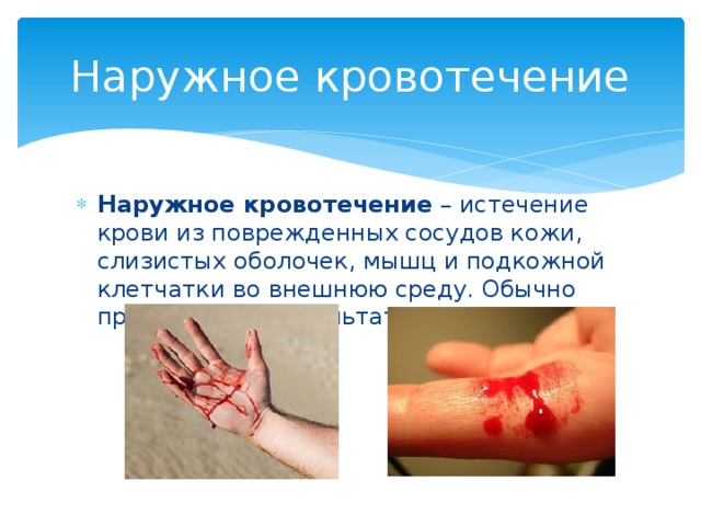 Наружное кровотечение Наружное кровотечение  – истечение крови из поврежденных сосудов кожи, слизистых оболочек, мышц и подкожной клетчатки во внешнюю среду. Обычно происходит в результате травмы. 