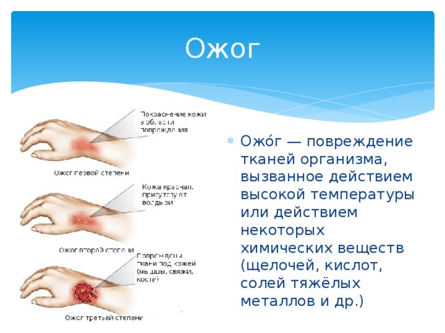 Ожог Ожо́г — повреждение тканей организма, вызванное действием высокой температуры или действием некоторых химических веществ (щелочей, кислот, солей тяжёлых металлов и др.) 