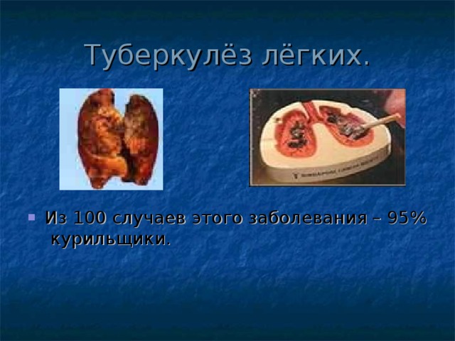 Туберкулёз лёгких. Из 100 случаев этого заболевания – 95% курильщики. 