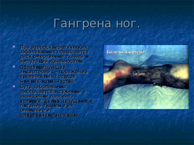 Гангрена ног. При атеросклеротических заболеваниях повышается риск омертвения тканей и ампутация конечностей. Облитерирующий эндартериит – поражение кровеносных сосудов нижних конечностей. Суть заболевания заключается в сужении и заращении просвета артерии, далее нарушается питание тканей и их онемение и омертвение(гангрена). 