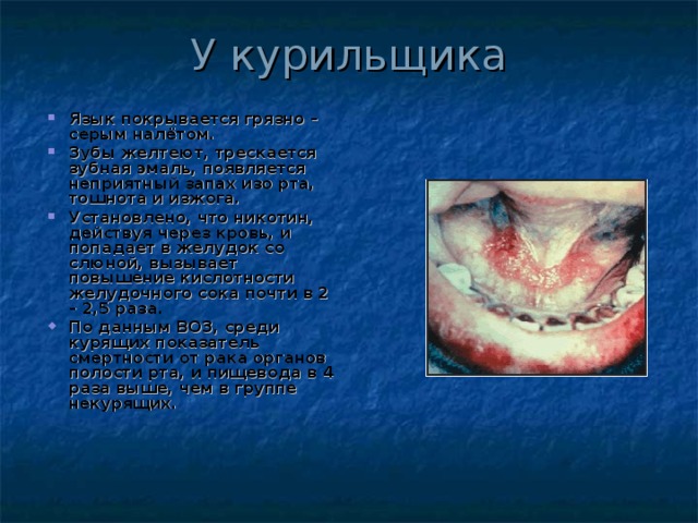 У курильщика Язык покрывается грязно – серым налётом. Зубы желтеют, трескается зубная эмаль, появляется неприятный запах изо рта, тошнота и изжога. Установлено, что никотин, действуя через кровь, и попадает в желудок со слюной, вызывает повышение кислотности желудочного сока почти в 2 – 2,5 раза. По данным ВОЗ, среди курящих показатель смертности от рака органов полости рта, и пищевода в 4 раза выше, чем в группе некурящих.  