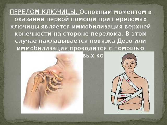 ПЕРЕЛОМ КЛЮЧИЦЫ. Основным моментом в оказании первой помощи при переломах ключицы является иммобилизация верхней конечности на стороне перелома. В этом случае накладывается повязка Дезо или иммобилизация проводится с помощью ватно-марлевых колец.    