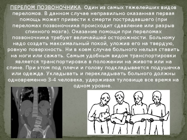 ПЕРЕЛОМ ПОЗВОНОЧНИКА . Один из самых тяжелейших видов переломов. В данном случае неправильно оказанная первая помощь может привести к смерти пострадавшего (при переломах позвоночника происходит сдавление или разрыв спинного мозга). Оказание помощи при переломах позвоночника требует величайшей осторожности. Больному надо создать максимальный покой, уложив его на твердую, ровную поверхность. Ни в коем случае больного нельзя ставить на ноги или сажать. Самым удобным видом транспортировки является транспортировка в положении на животе или на спине. При этом под плечи и голову подкладывается подушечка или одежда. Укладывать и перекладывать больного должны одновременно 3-4 человека, удерживая туловище все время на одном уровне.    