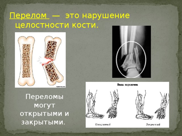 Перелом — это нарушение целостности кости. Переломы могут открытыми и закрытыми. 