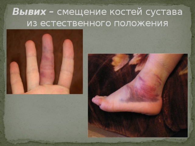 Вывих – смещение костей сустава из естественного положения 