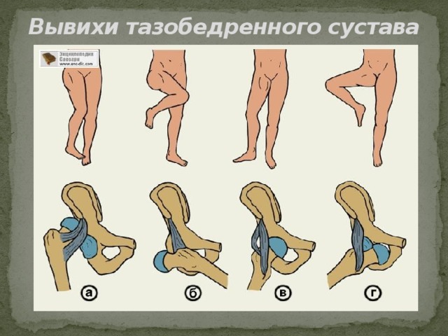 Вывихи тазобедренного сустава 