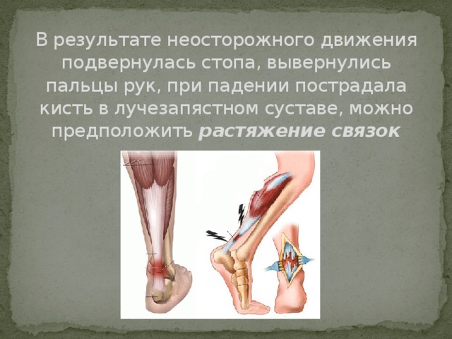 В результате неосторожного движения подвернулась стопа, вывернулись пальцы рук, при падении пострадала кисть в лучезапястном суставе, можно предположить растяжение связок 