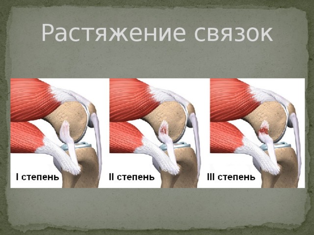 Растяжение связок 