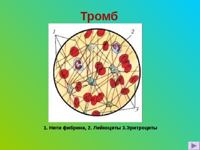Тромб  1. Нити фибрина, 2. Лейкоциты 3.Эритроциты 