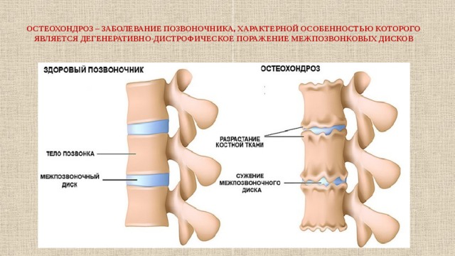  ОСТЕОХОНДРОЗ – ЗАБОЛЕВАНИЕ ПОЗВОНОЧНИКА, ХАРАКТЕРНОЙ ОСОБЕННОСТЬЮ КОТОРОГО ЯВЛЯЕТСЯ ДЕГЕНЕРАТИВНО-ДИСТРОФИЧЕСКОЕ ПОРАЖЕНИЕ МЕЖПОЗВОНКОВЫХ ДИСКОВ   