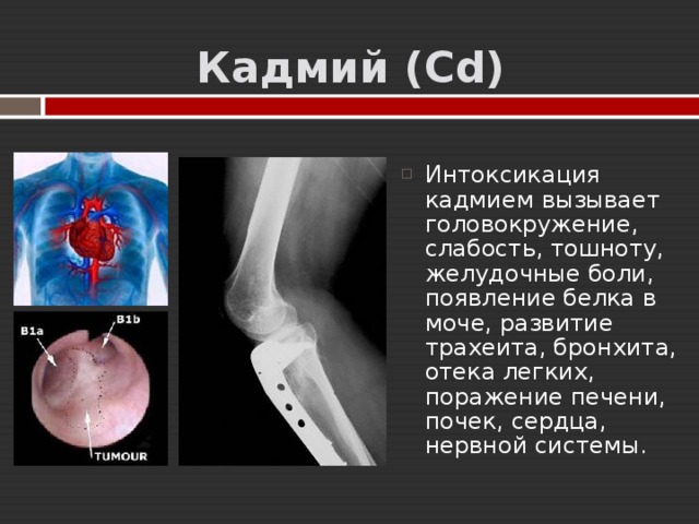  Кадмий  ( Cd ) Интоксикация кадмием вызывает головокружение, слабость, тошноту, желудочные боли, появление белка в моче, развитие трахеита, бронхита, отека легких, поражение печени, почек, сердца, нервной системы. 