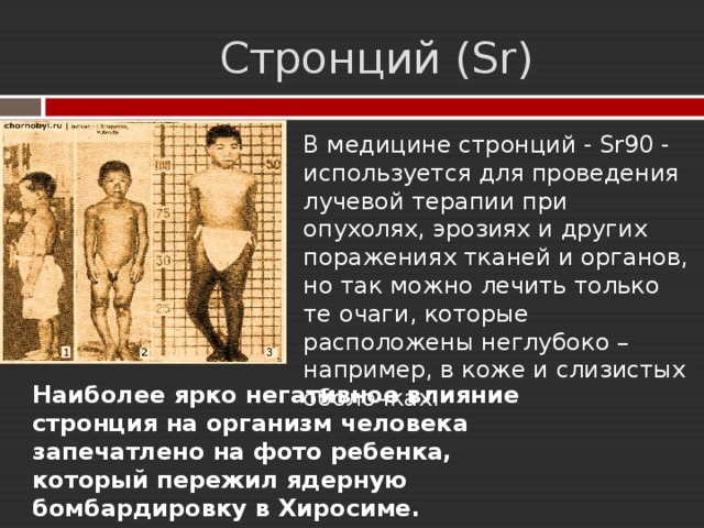  Стронций (Sr) В медицине стронций - Sr90 - используется для проведения лучевой терапии при опухолях, эрозиях и других поражениях тканей и органов, но так можно лечить только те очаги, которые расположены неглубоко – например, в коже и слизистых оболочках.      Наиболее ярко негативное влияние стронция на организм человека запечатлено на фото ребенка, который пережил ядерную бомбардировку в Хиросиме. 