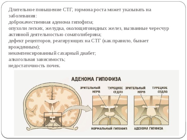 Длительное повышение СТГ, гормона роста может указывать на заболевания:  доброкачественная аденома гипофиза;  опухоли легких, желудка, околощитовидных желез, вызванные чересчур активной деятельностью соматолиберина;  дефект рецепторов, реагирующих на СТГ (как правило, бывает врожденным);  некомпенсированный сахарный диабет;  алкогольная зависимость;  недостаточность почек. 