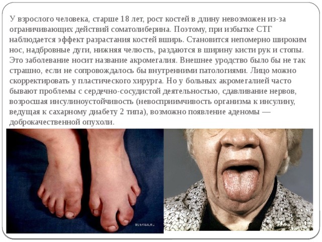 У взрослого человека, старше 18 лет, рост костей в длину невозможен из-за ограничивающих действий соматолиберина. Поэтому, при избытке СТГ наблюдается эффект разрастания костей вширь. Становится непомерно широким нос, надбровные дуги, нижняя челюсть, раздаются в ширину кисти рук и стопы. Это заболевание носит название акромегалия. Внешнее уродство было бы не так страшно, если не сопровождалось бы внутренними патологиями. Лицо можно скорректировать у пластического хирурга. Но у больных акромегалией часто бывают проблемы с сердечно-сосудистой деятельностью, сдавливание нервов, возросшая инсулиноустойчивость (невосприимчивость организма к инсулину, ведущая к сахарному диабету 2 типа), возможно появление аденомы — доброкачественной опухоли.    