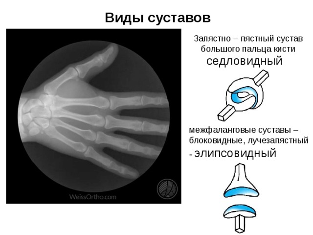 Виды суставов Запястно – пястный сустав большого пальца кисти седловидный межфаланговые суставы – блоковидные, лучезапястный - элипсовидный 