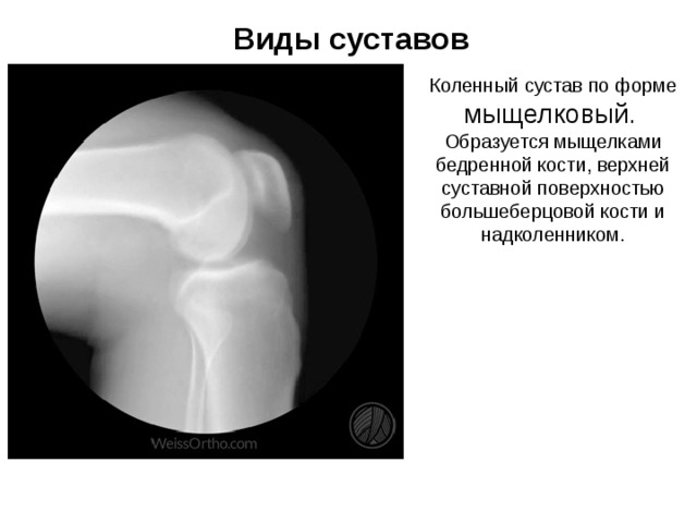 Виды суставов Коленный сустав по форме мыщелковый . Образуется мыщелками бедренной кости, верхней суставной поверхностью большеберцовой кости и надколенником. 