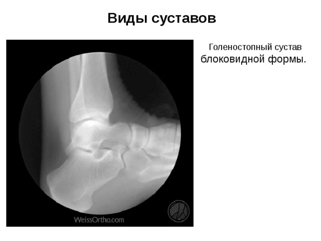Виды суставов Голеностопный сустав блоковидной формы. 