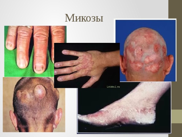 Микозы 