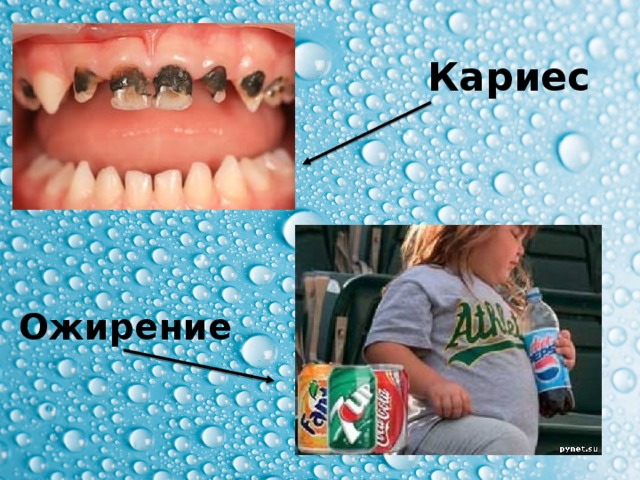 Кариес Ожирение 