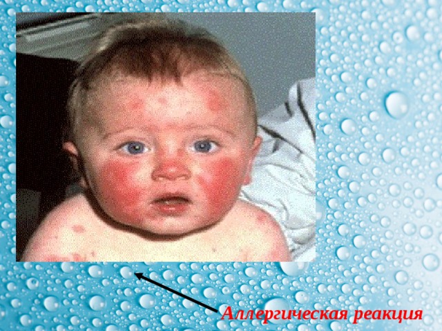 Аллергическая реакция 