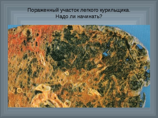 Пораженный участок легкого курильщика.  Надо ли начинать? 