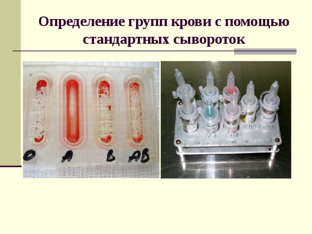 Определение групп крови с помощью стандартных сывороток 