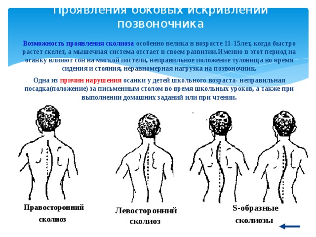 Проявления боковых искривлений позвоночника Возможность проявления сколиоза особенно велика в возрасте 11-15лет, когда быстро растет скелет, а мышечная система отстает в своем развитии.Именно в этот период на осанку влияют сон на мягкой постели, неправильное положение туловища во время сидения и стояния, неравномерная нагрузка на позвоночник. Одна из причин нарушения осанки у детей школьного возраста- неправильная посадка(положение) за письменным столом во время школьных уроков, а также при выполнении домашних заданий или при чтении. Правосторонний сколиоз  S-образные сколиозы  Левосторонний сколиоз 