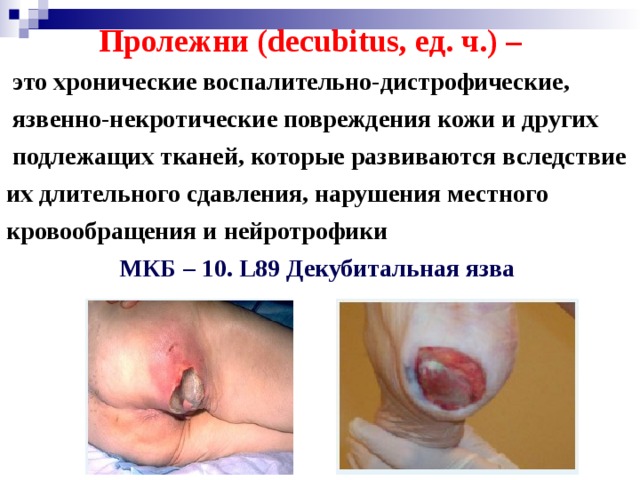  Пролежни ( decubitus , ед. ч.) –   это хронические воспалительно-дистрофические,  язвенно-некротические повреждения кожи и других  подлежащих тканей, которые развиваются вследствие их длительного сдавления, нарушения местного кровообращения и нейротрофики МКБ – 10. L 89 Декубитальная язва 