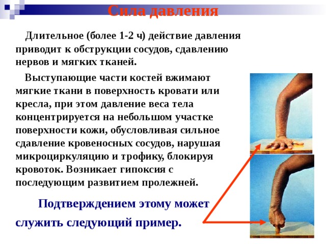 Сила давления  Длительное (более 1-2 ч) действие давления приводит к обструкции сосудов, сдавлению нервов и мягких тканей.  Выступающие части костей вжимают мягкие ткани в поверхность кровати или кресла, при этом давление веса тела концентрируется на небольшом участке поверхности кожи, обусловливая сильное сдавление кровеносных сосудов, нарушая микроциркуляцию и трофику, блокируя кровоток. Возникает гипоксия с последующим развитием пролежней.  Подтверждением этому может служить следующий пример. 