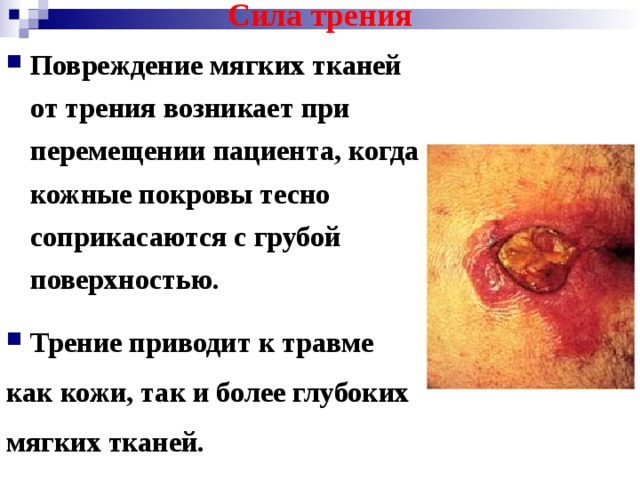 Сила трения Повреждение мягких тканей от трения возникает при перемещении пациента, когда кожные покровы тесно соприкасаются с грубой поверхностью.  Трение приводит к травме как кожи, так и более глубоких мягких тканей. 