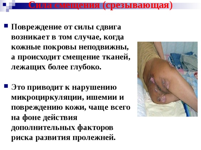 Сила смещения (срезывающая) Повреждение от силы сдвига возникает в том случае, когда кожные покровы неподвижны, а происходит смещение тканей, лежащих более глубоко.  Это приводит к нарушению микроциркуляции, ишемии и повреждению кожи, чаще всего на фоне действия дополнительных факторов риска развития пролежней. 