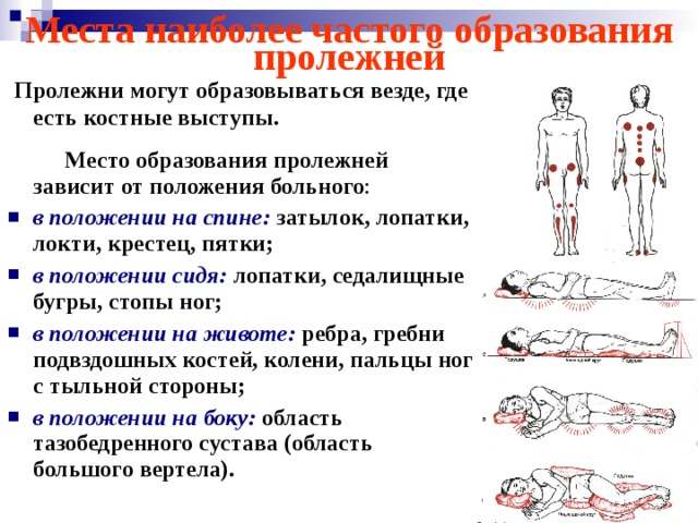 Места наиболее частого образования пролежней  Пролежни могут образовываться везде, где есть костные выступы.   Место образования пролежней зависит от положения больного : в положении на спине: затылок, лопатки, локти, крестец, пятки; в положении сидя:  лопатки, седалищные бугры, стопы ног; в положении на животе: ребра, гребни подвздошных костей, колени, пальцы ног с тыльной стороны; в положении на боку: область тазобедренного сустава (область большого вертела). 
