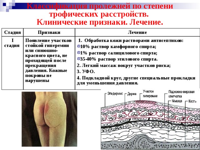 Классификация пролежней по степени трофических расстройств.  Клинические признаки. Лечение. Стадия Признаки I стадия Лечение Появление участков стойкой гиперемии или синюшно-красного цвета, не проходящей после прекращения давления. Кожные покровы не нарушены  1. Обработка кожи растворами антисептиков: 10% раствор камфорного спирта; 1% раствор салицилового спирта; 35-40% раствор этилового спирта. 2. Легкий массаж вокруг участков риска; 3. УФО. 4. Подкладной круг, другие специальные прокладки для уменьшения давления. 