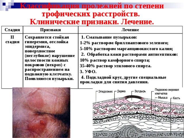 Классификация пролежней по степени трофических расстройств.  Клинические признаки. Лечение. Стадия Признаки II стадия Лечение Сохраняется стойкая гиперемия, отслойка эпидермиса, поверхностное (неглубокое) нарушение целостности кожных покровов (некроз) с распространением на подкожную клетчатку. Появляются пузырьки.  1. Смазывание пузырьков: 1-2% раствором бриллиантового зеленого; 5-10% раствором марганцовокислого калия;  2. Обработка кожи растворами антисептиков: 10% раствор камфорного спирта; 35-40% раствор этилового спирта. 3. УФО.  4. Подкладной круг, другие специальные прокладки для снятия давления. 