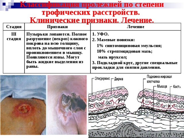 Классификация пролежней по степени трофических расстройств.  Клинические признаки. Лечение. Стадия Признаки II I  стадия Лечение Пузырьки лопаются. Полное разрушение (некроз) кожного покрова на всю толщину, вплоть до мышечного слоя с проникновением в мышцу. Появляются язвы. Могут быть жидкие выделения из раны. 1. УФО. 2. Мазевые повязки:  1% синтомициновая эмульсия;  10% стрептоцидовая мазь;  мазь ируксол; 3. Подкладной круг, другие специальные прокладки для снятия давления. 