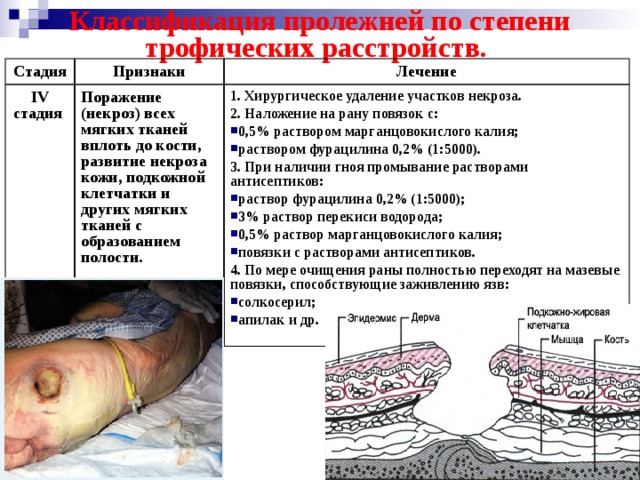 Классификация пролежней по степени трофических расстройств. Стадия Признаки IV стадия Лечение Поражение (некроз) всех мягких тканей вплоть до кости, развитие некроза кожи, подкожной клетчатки и других мягких тканей с образованием полости. 1. Хирургическое удаление участков некроза. 2. Наложение на рану повязок с: 0,5% раствором марганцовокислого калия; раствором фурацилина 0,2% (1:5000). 3. При наличии гноя промывание растворами антисептиков: раствор фурацилина 0,2% (1:5000); 3% раствор перекиси водорода; 0,5% раствор марганцовокислого калия; повязки с растворами антисептиков. 4. По мере очищения раны полностью переходят на мазевые повязки, способствующие заживлению язв: солкосерил; апилак и др. 