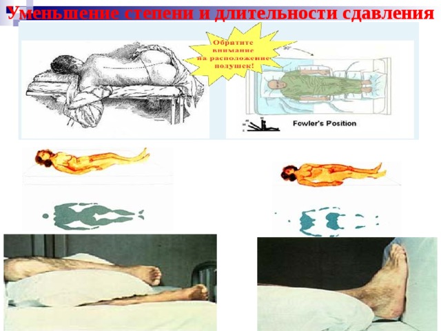 Уменьшение степени и длительности сдавления 
