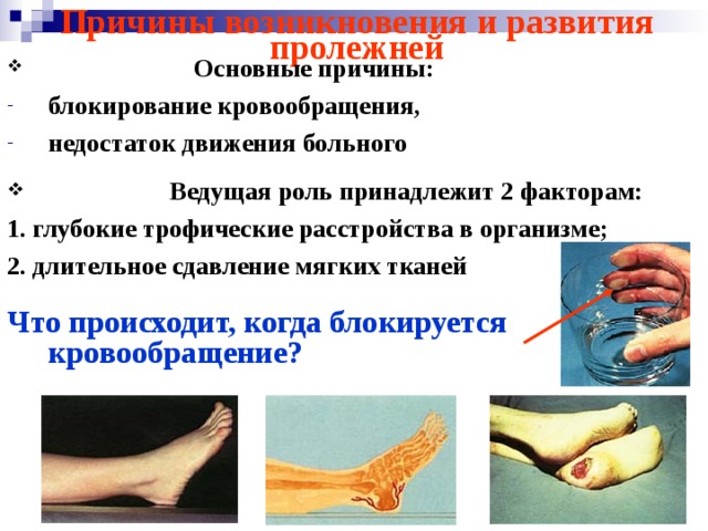 Причины возникновения и развития пролежней  Основные причины: блокирование кровообращения, недостаток движения больного   Ведущая роль принадлежит 2 факторам: 1. глубокие трофические расстройства в организме; 2. длительное сдавление мягких тканей  Что происходит, когда блокируется кровообращение?  