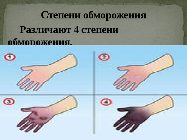 Степени обморожения  Различают 4 степени обморожения. 
