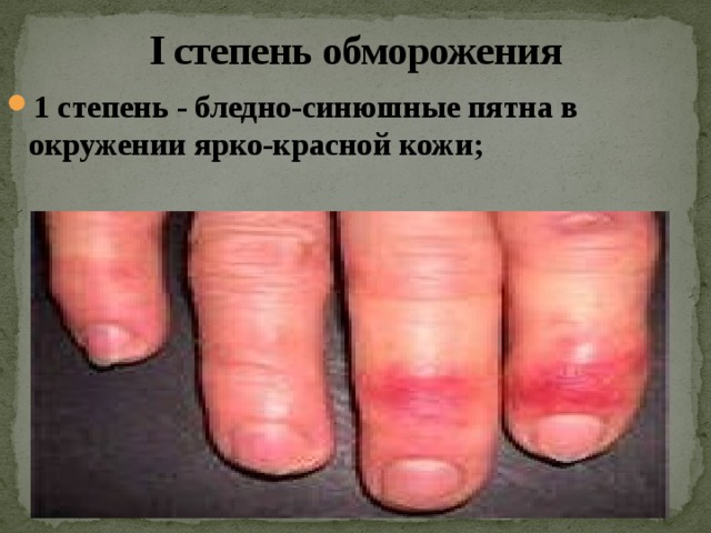 I степень обморожения 1 степень - бледно-синюшные пятна в окружении ярко-красной кожи; 